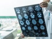 ASTUCE Spain reclama a Sanitat el reconeixement de l’oligodendroglioma
